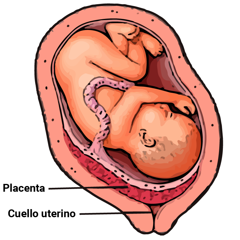 imagen de placenta previa